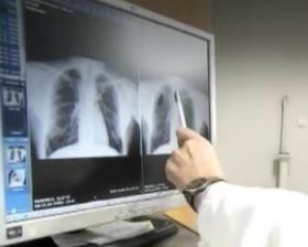 В Казахстане показатель смертности от туберкулеза  в первом квартале 2015 года   упал на 10%